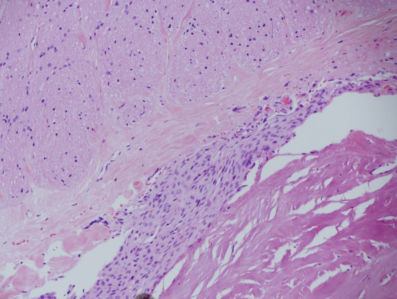 An Unusual Radiological Presentation of Optic Nerve Sheath Meningioma